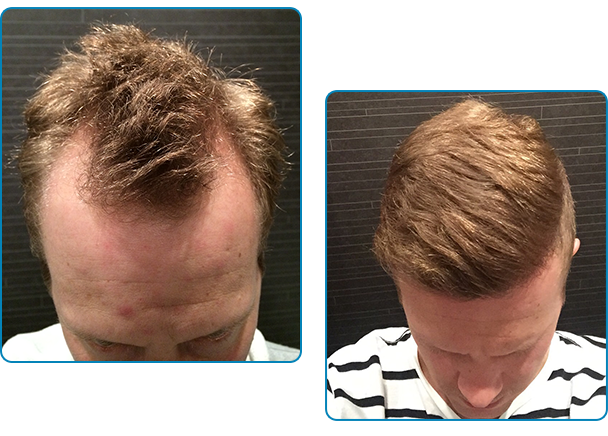 Före och efter bilder